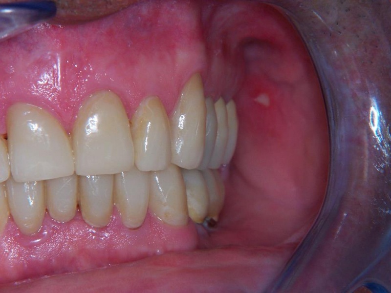 Caso Clinico 3: Riabilitazione delle due arcate mediante ponti in metallo ceramica, corone e faccette in ceramica integrale emax