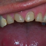 Caso Clinico 3: Grave usura dentale associata a perdita di dimensione verticale 